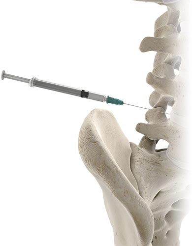 lumbar spine injection 3d rendered model